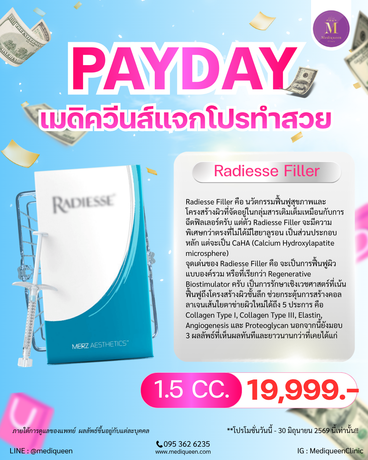 Radiesse Filler