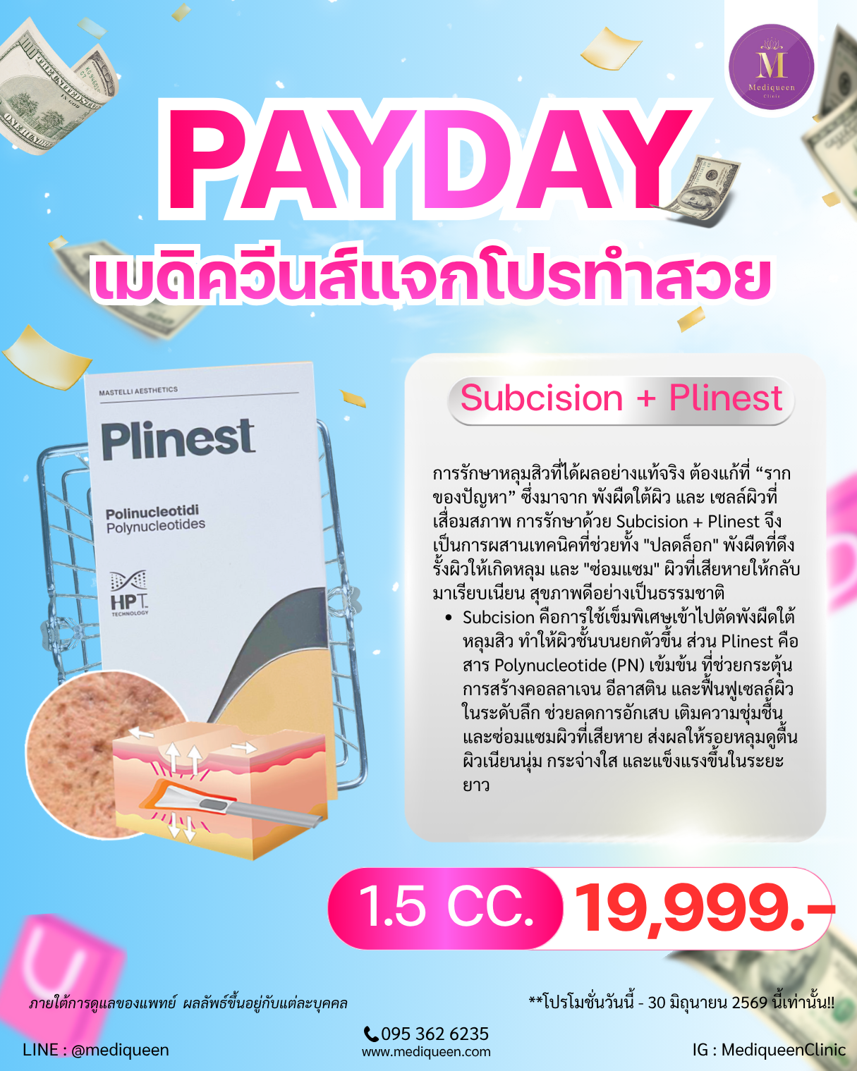 Subcision + Plinest
