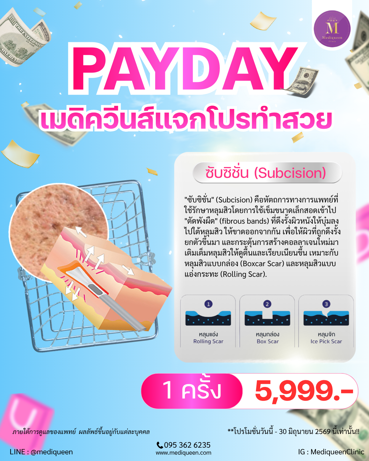 ซับซิชั่น (Subcision)