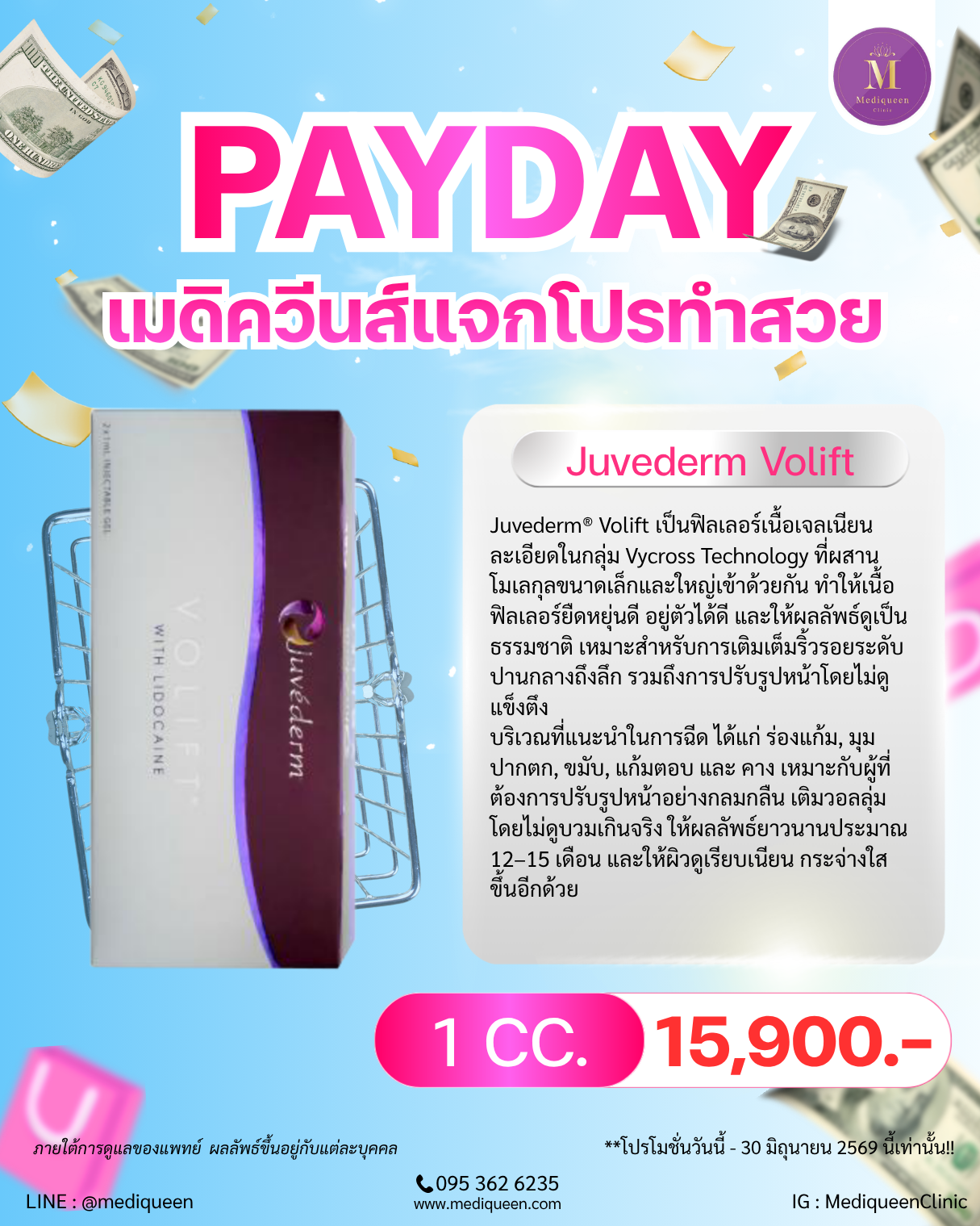 Juvederm Volift