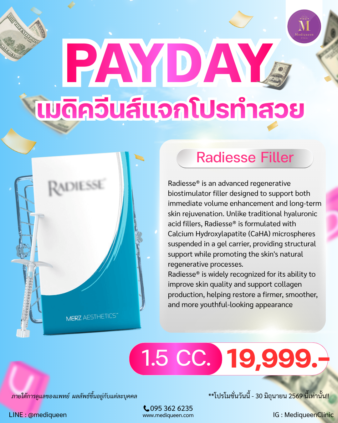 Radiesse Filler