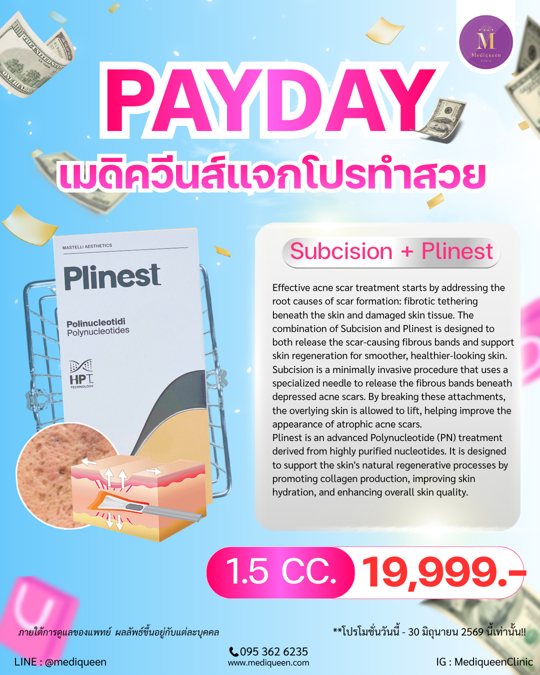 Subcision + Plinest