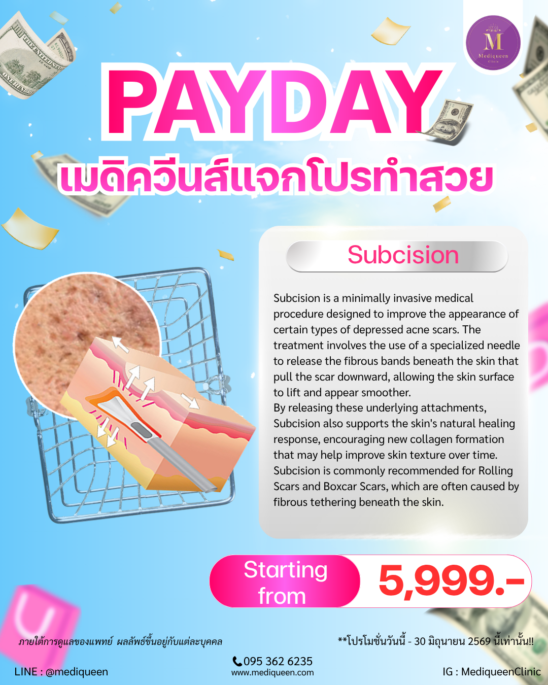 Subcision