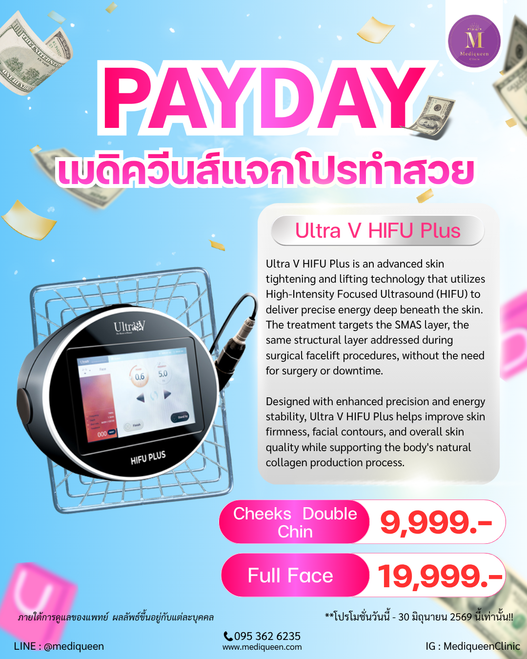 Ultra V HIFU Plus