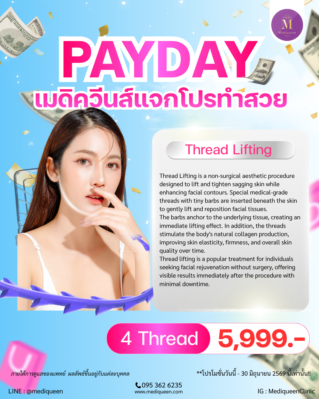 Thread Lifting 4 Thread
