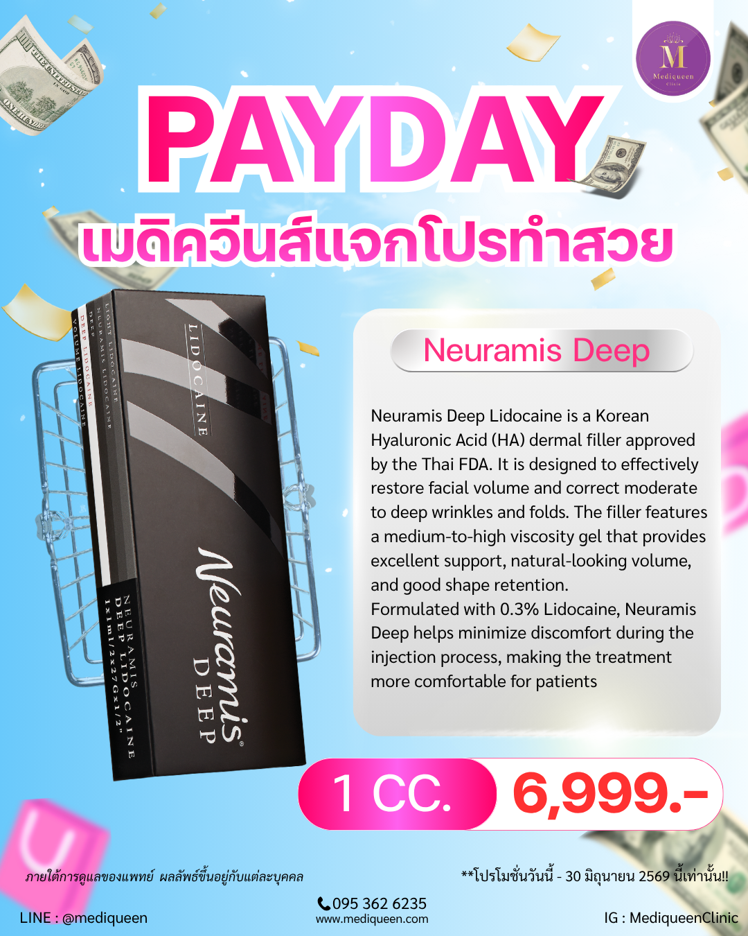 Neuramis Deep Lidocaine