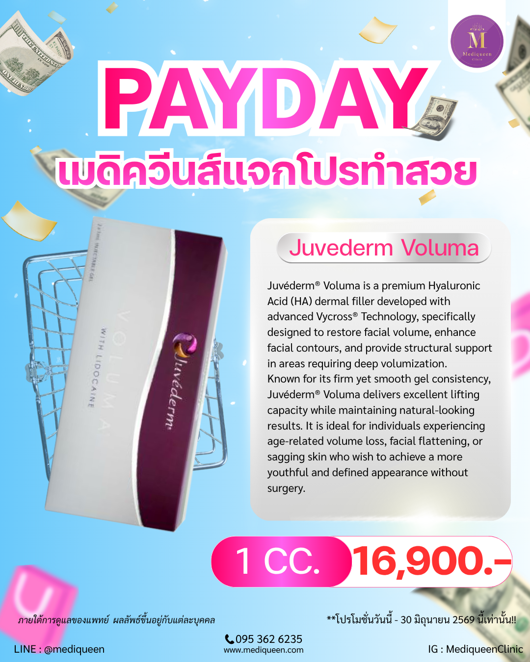 Juvéderm® Voluma