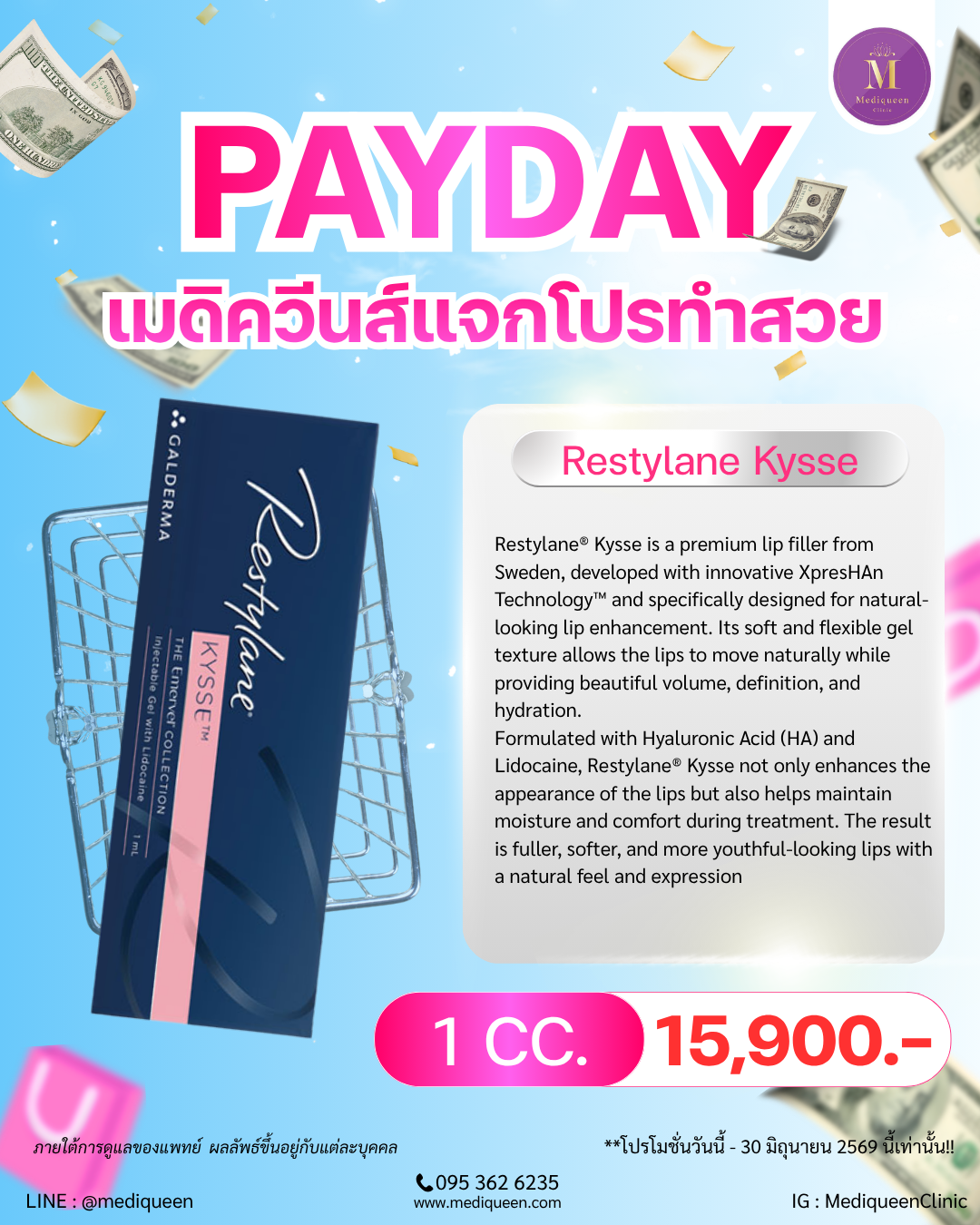 Restylane® Kysse