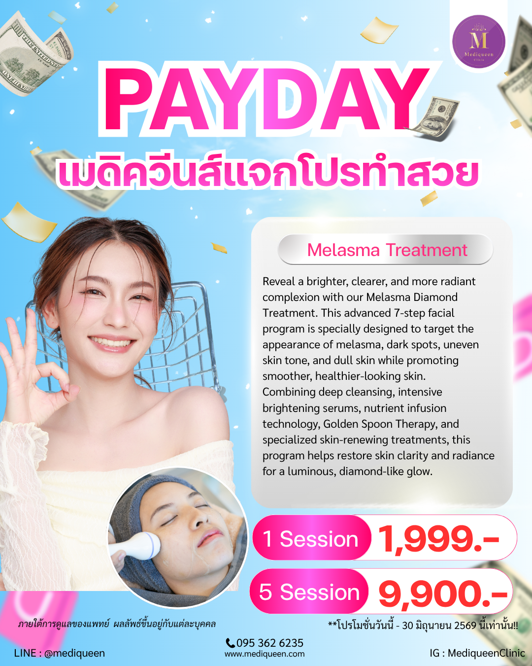 MELASMA DIAMOND TREATMENT